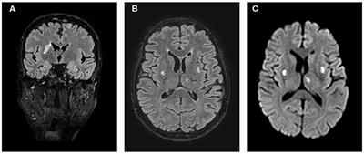 Microscopic Polyangiitis With Selective Involvement of Central and Peripheral Nervous System: A Case Report